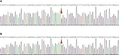 Case report: Curing a rare, unstable hemoglobin variant Hb Bristol-Alesha using haploidentical hematopoietic stem cell transplantation